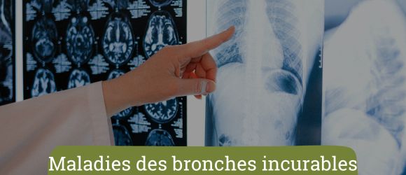You are currently viewing Les traitements pour les maladies des bronches incurables
